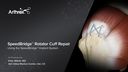Arthroscopic SpeedBridge™ Double Row Rotator Cuff Repair