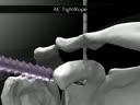 resection acromio claviculaire